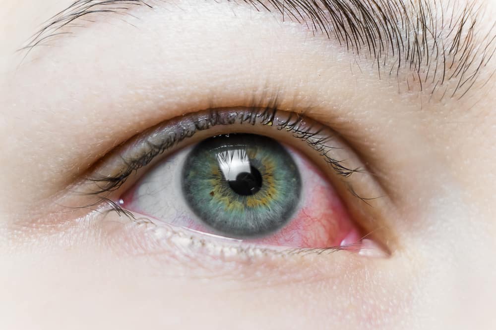 simple-ways-to-avoid-pink-eye-this-winter