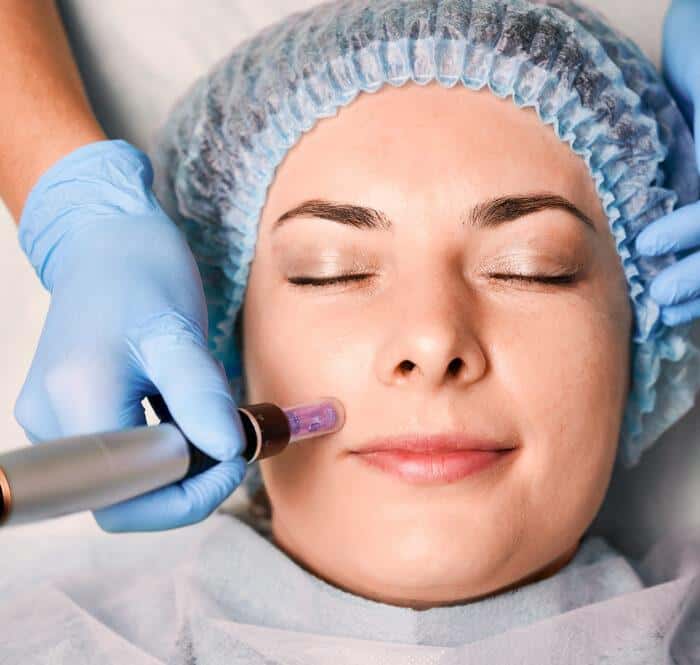 A New Era In Skincare Exploring The Transformative Effects Of SkinPen Microneedling