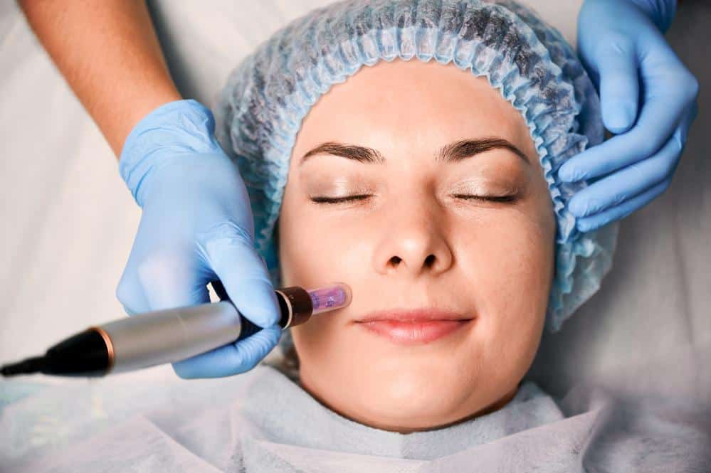 A New Era In Skincare Exploring The Transformative Effects Of SkinPen Microneedling
